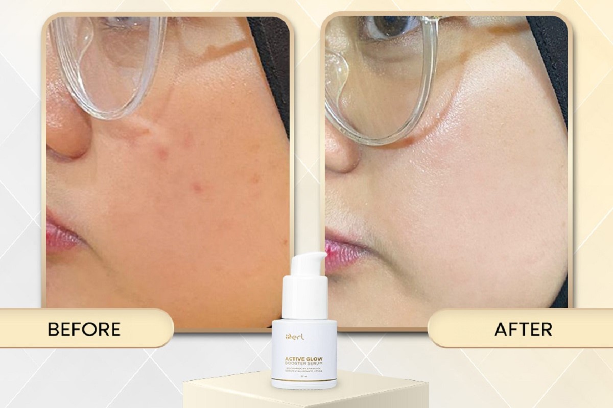 Pori Besar, Minyak Berlebih, dan Kulit Cepat Kusam? AGB dengan Niacinamide 8% & Bakuchiol Bisa Jadi Jawabannya