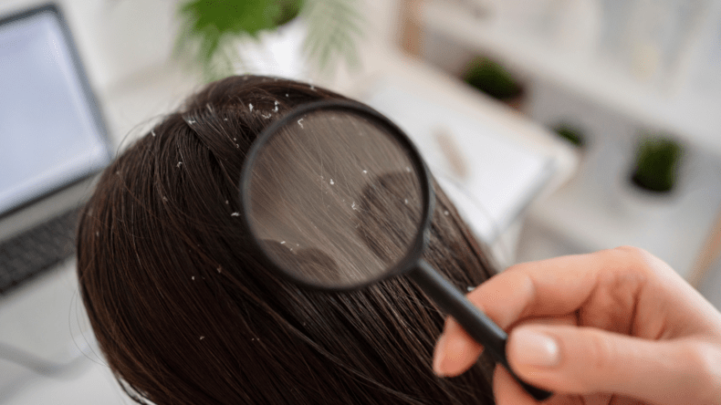 7 Cara Ampuh Menghilangkan Kutu Rambut, Yuk Coba!